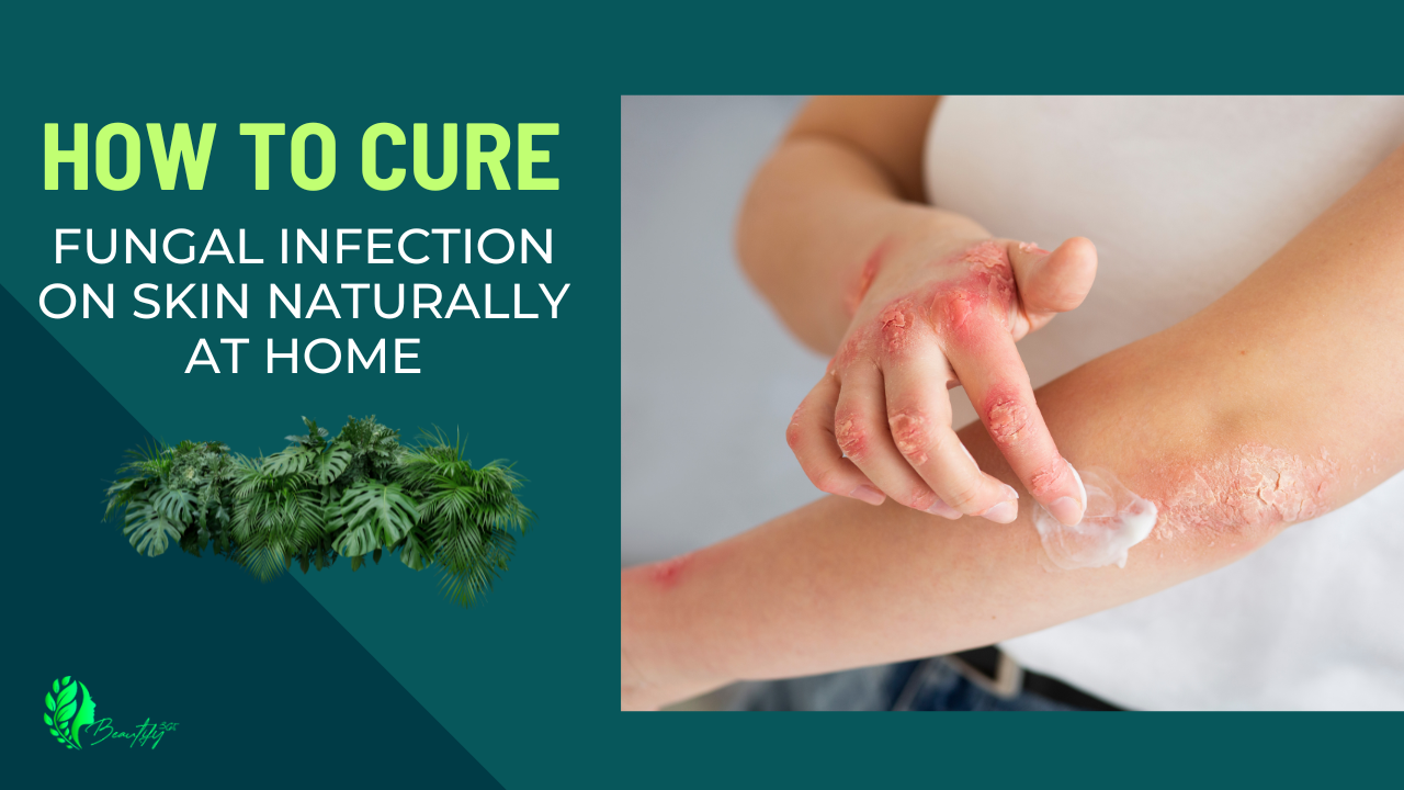 How to Cure Fungal Infection on Skin Naturally at Home - 5 Easy Steps